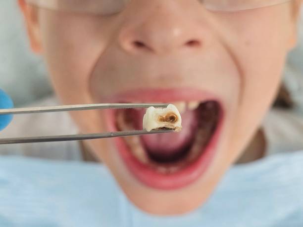 Best Emergency Dental Extractions in Edgewood, WA