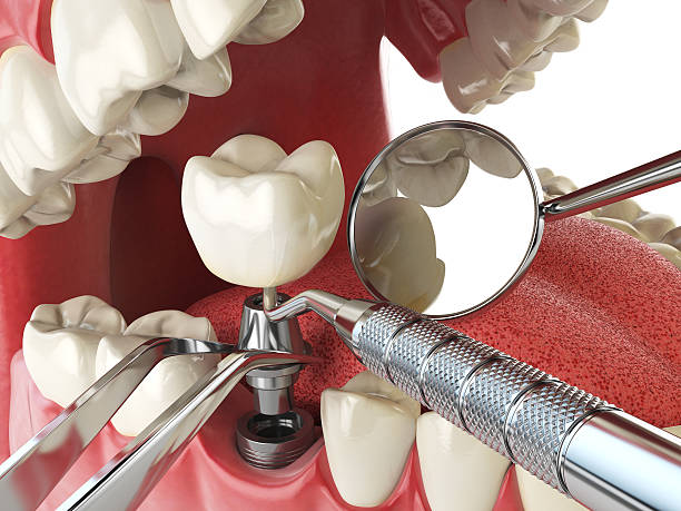 Best Emergency Dentist for Knocked-Out Tooth in Edgewood, WA